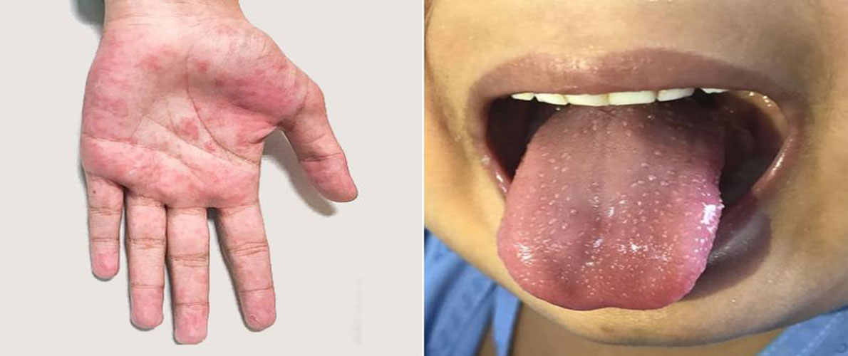 ما هو مرض كاواساكي ؟